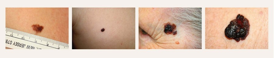 Attēls At&scaron;ķirīgi melanomas veidi un attīstības stadijas makroskopiski
