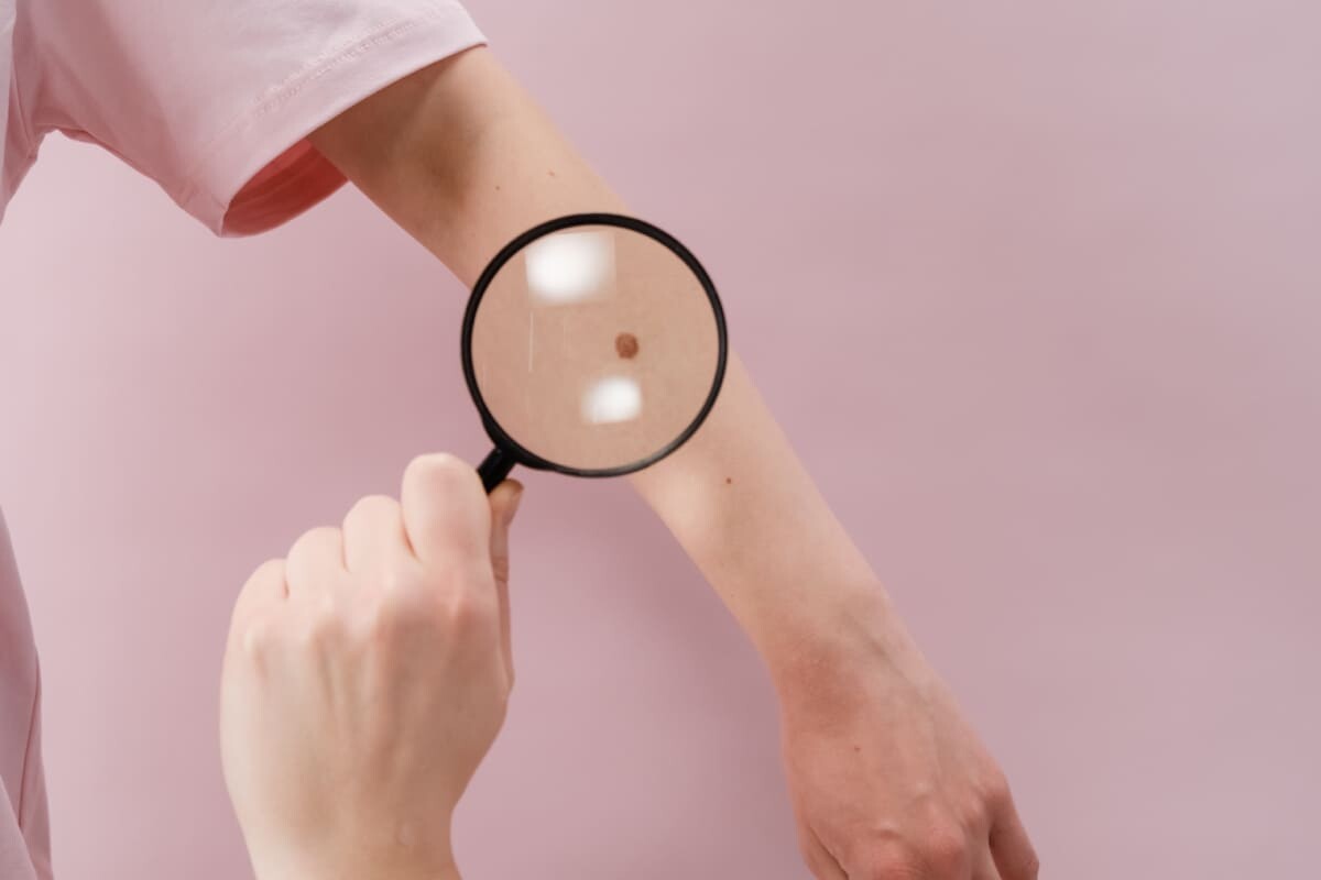 Dzimumzīmītes biopsija Rīgā