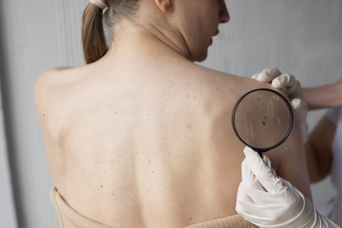 Dermatologa konsultācija Rīgā
