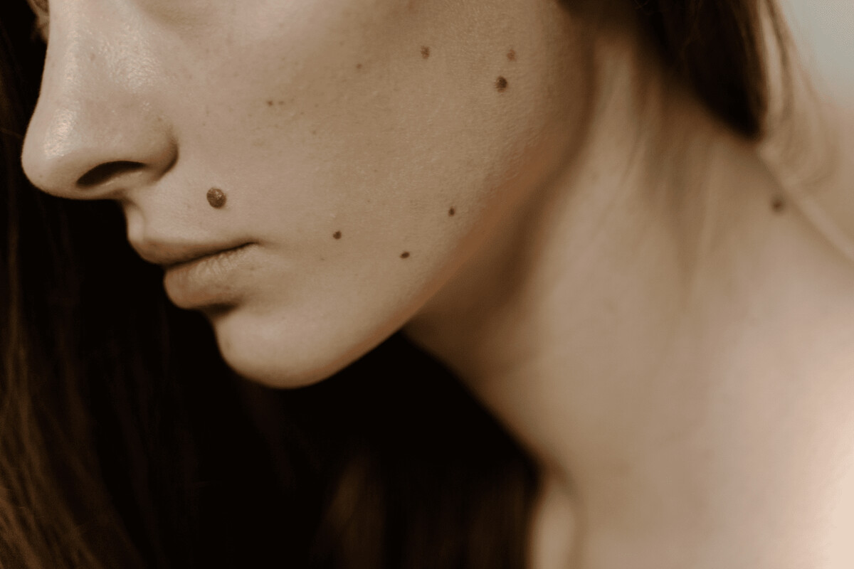 Dzimumzīmju pārbaude – dermatologs Rīgā
